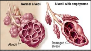 emphysema