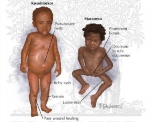 Kwashiorkor-and-Marasmus